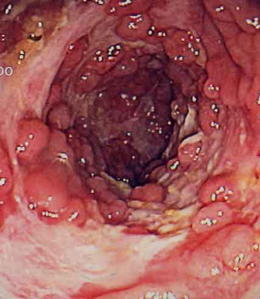 Photograph is an Intestine of Crohn’s disease patient. 